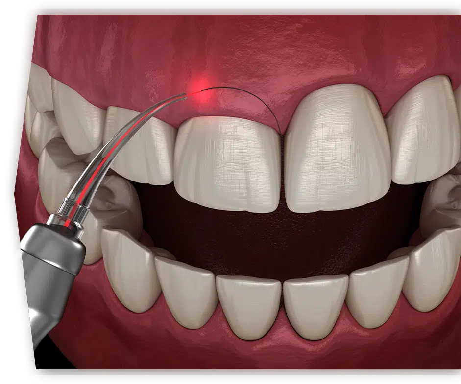 Gingivectomy in South Austin