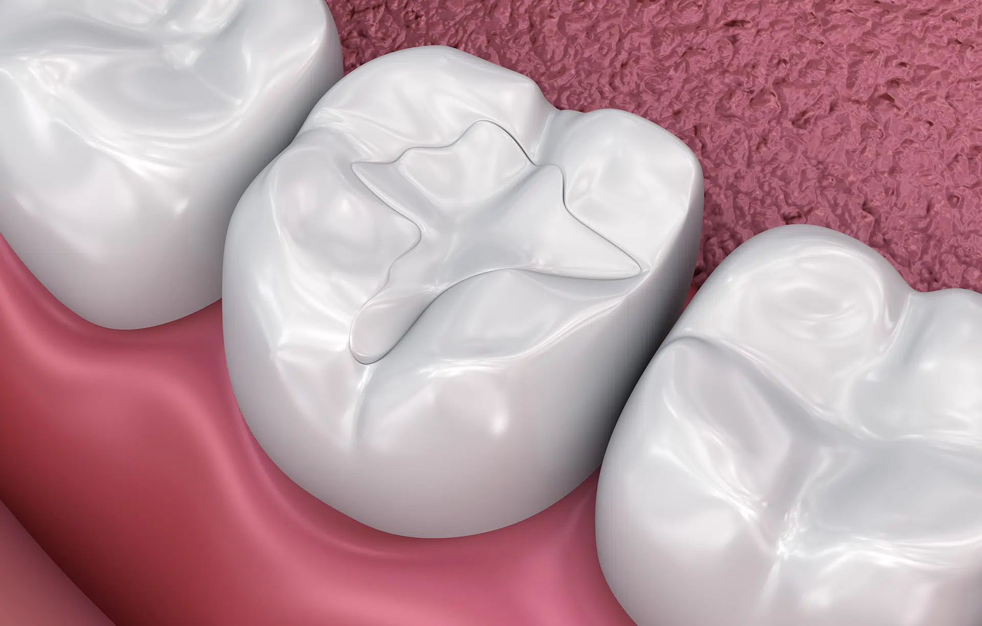 Composite Fillings in South Austin